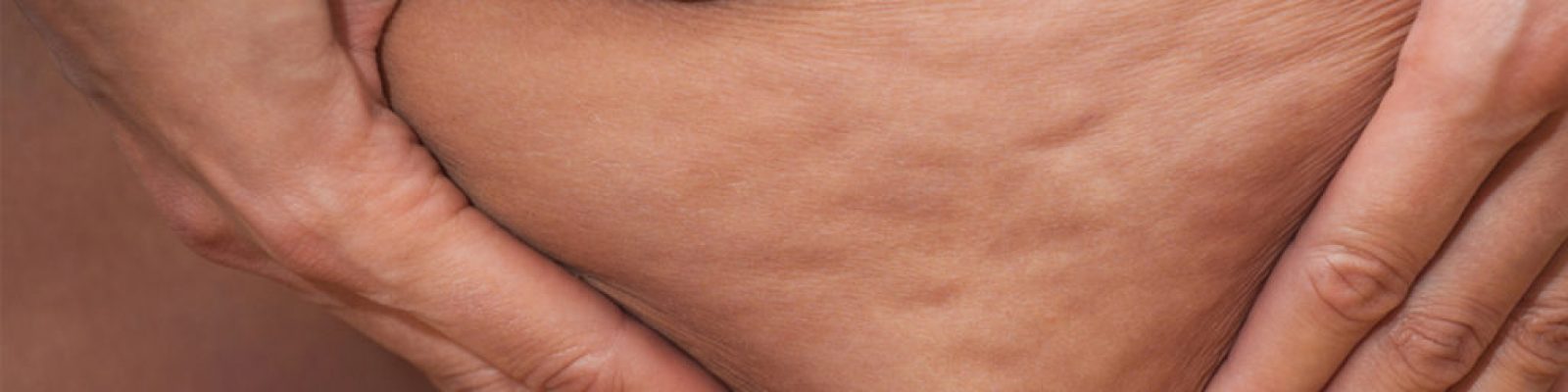 Cellulite-femme-enceinte-1024x768-1